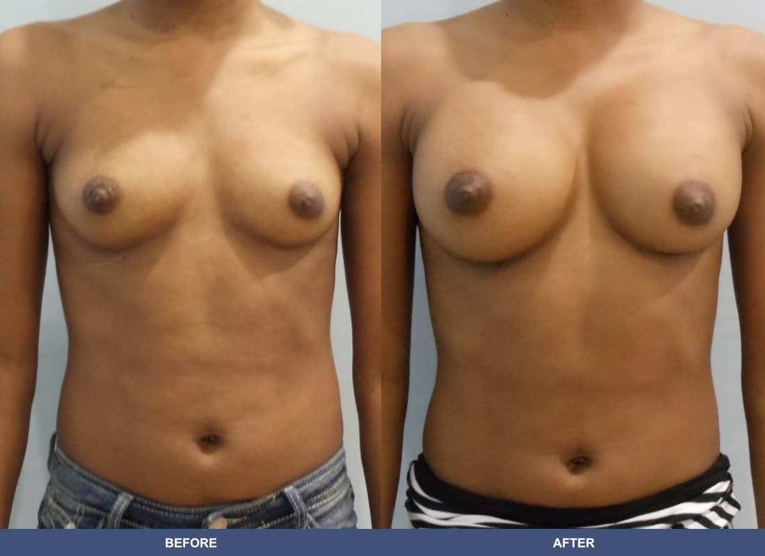Painless Breast Implants before and after