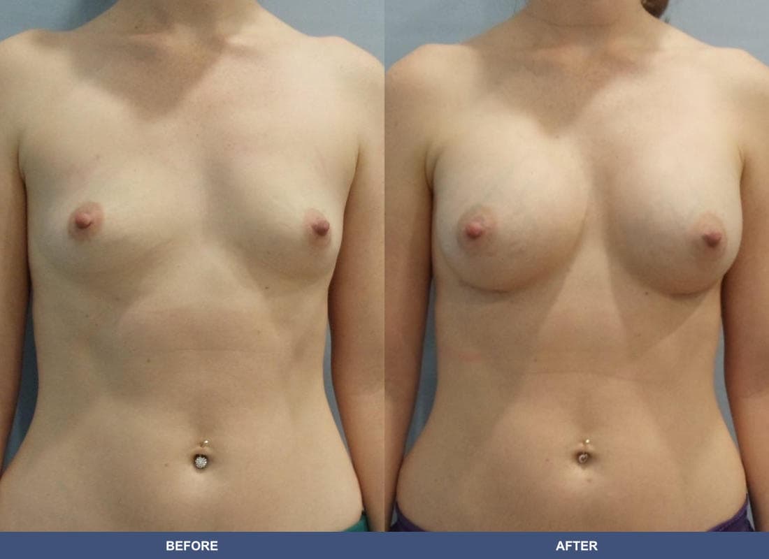 Painless Breast Implants before and after
