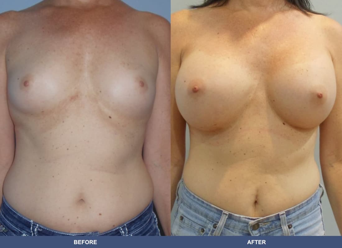 Painless Breast Implants before and after
