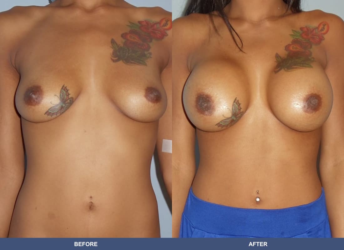 Painless Breast Implants before and after
