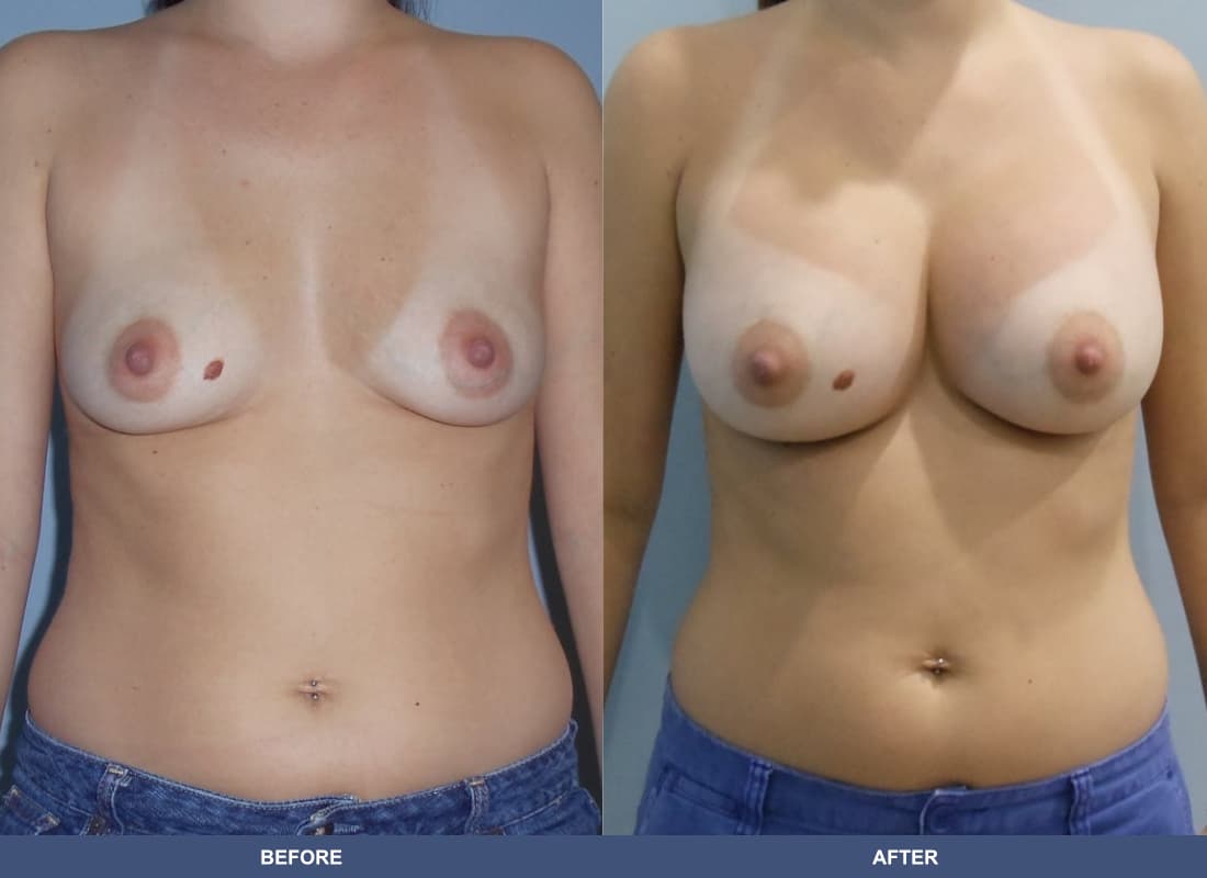Painless Breast Implants before and after