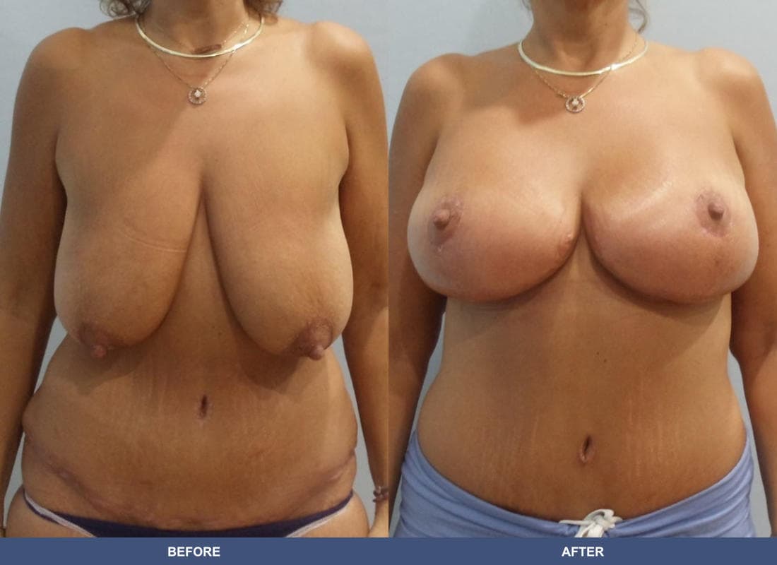Breast Lift / Reduction before and after