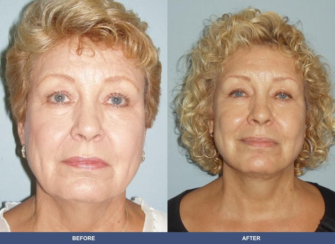 Face and Neck Lift before and after