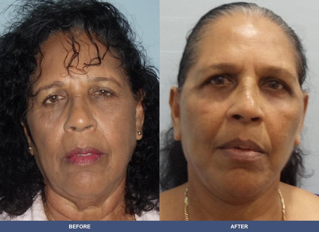 Face and Neck Lift before and after
