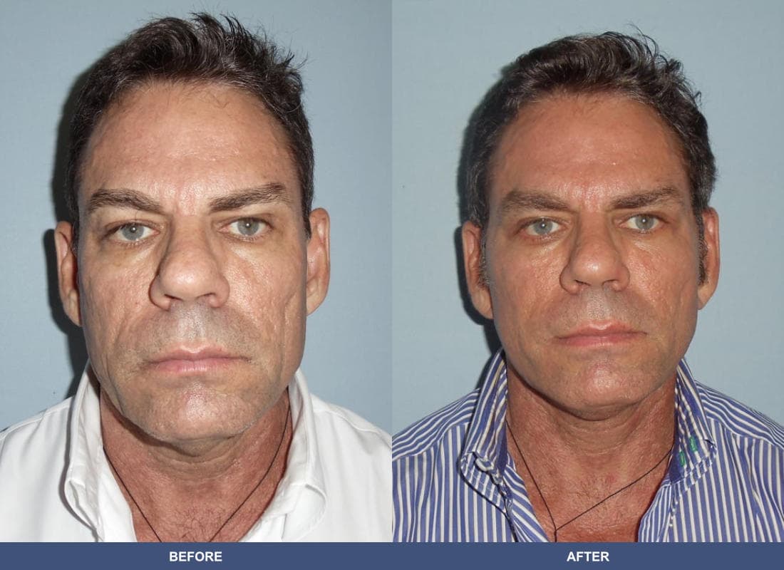 Face and Neck Lift before and after