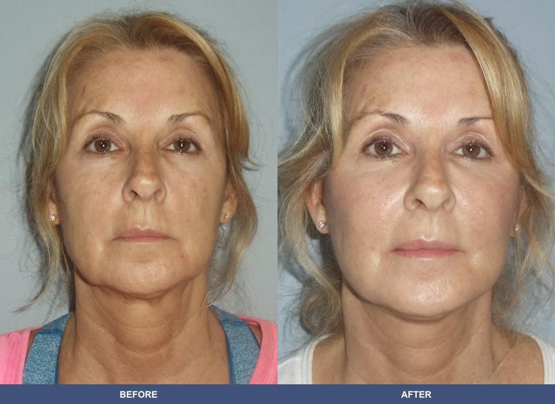 Face and Neck Lift before and after