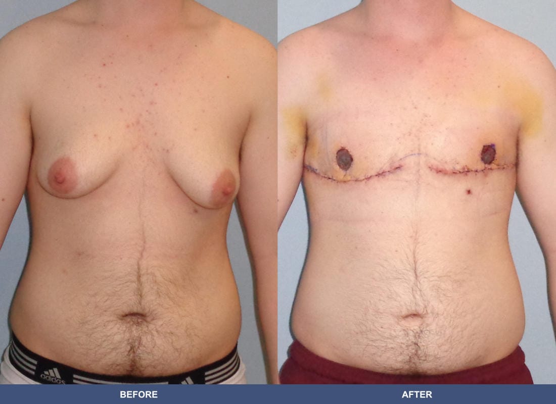 Gender Confirmation (FTM) before and after