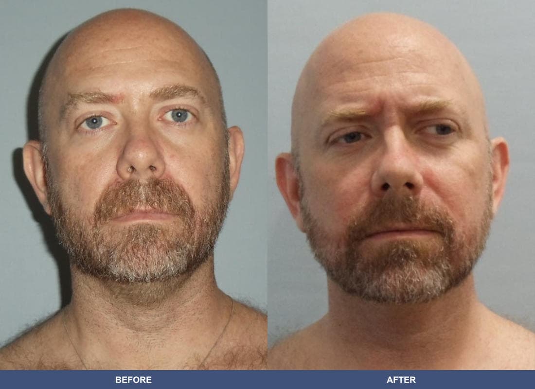 Liposuction before and after
