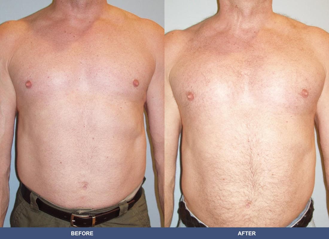 Pectoral Augmentation before and after