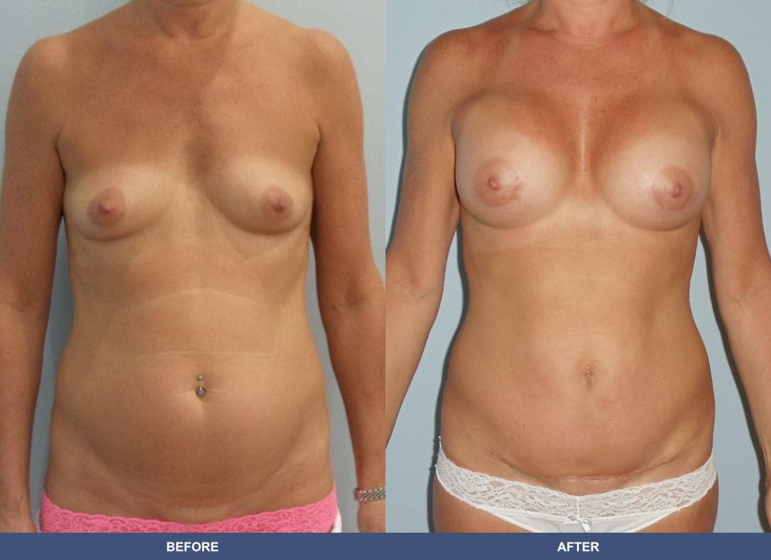 Tummy Tuck before and after